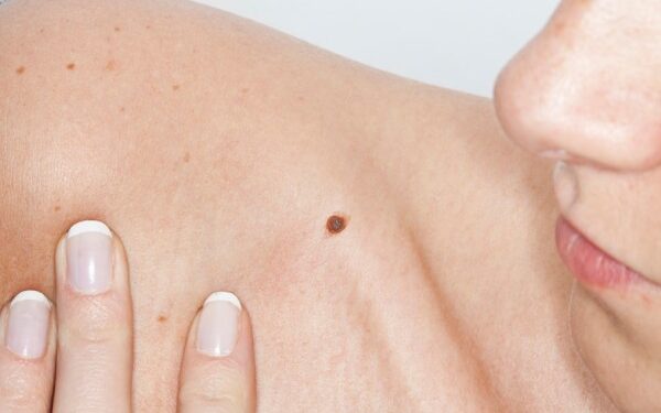 Emiten recomendaciones para prevenir el cáncer de piel